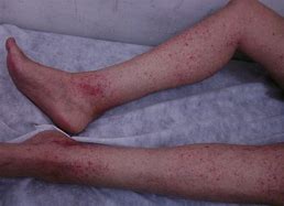 Image result for Post-Viral Vasculitis