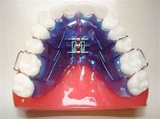 apparecchio mobile apparecchio dentale ortodonzia dott marco dormi apparecchio mobile apparecchio dentale ortodonzia dott marco dormi