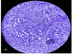 Image result for Biphasic Synovial Sarcoma