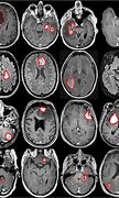 Image result for Brain Cancer MRI Scan