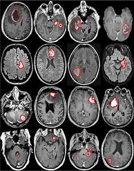 Image result for CT Scan Brain MS