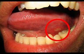 Image result for Tongue Warts Pictures