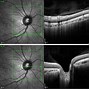 Image result for Oct Scan Optic Nerve