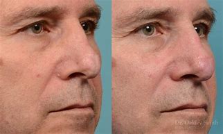 Image result for Scar Removal On Nose