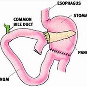Image result for Whipple Procedure Roux En Y