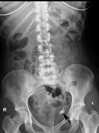 Image result for 5Cm Ovarian Cyst