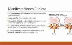 Image result for acondeoplasia