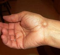 Image result for Lump On My Wrist