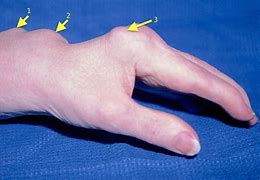 Image result for Synovitis Finger