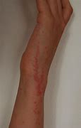 Image result for Common Bed Bug Bites