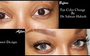 Image result for Surgery Eye Color Permanent