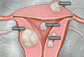 Image result for Posterior Fibroid