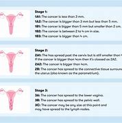 Image result for Stage 2 Cervical Cancer