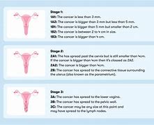 Image result for CA Cervix