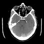 Image result for T2 MRI Veins Axial