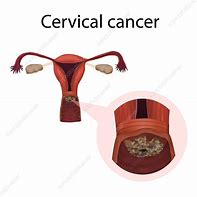 Image result for Cervical Cancer Drawing