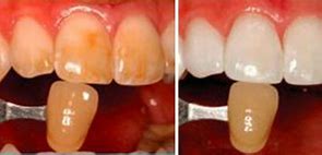Image result for Kor Teeth Whitening