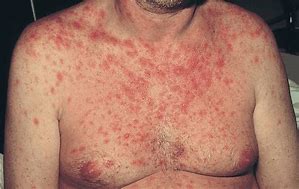 Image result for HIV Skin Lesions