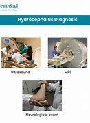 Image result for Hydrocephalus Diagnosis