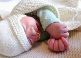 Image result for Baby Born with Anencephaly What Does the Baby Look Like