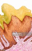 Image result for Warts On the Back