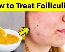 Image result for Folliculitis Cure