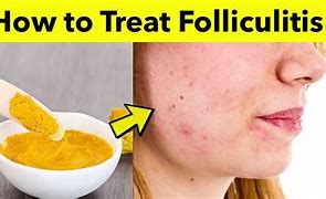 Image result for Hair Folliculitis Treatment