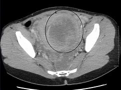 Image result for 4 Cm Fibroid Tumor
