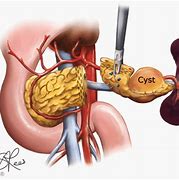Image result for Pancreatic Cyst