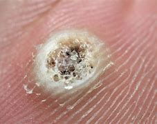 Image result for Head Warts