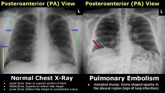 Image result for Abnormal Chest X-Ray