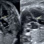 Image result for Bicuspid Aortic Valve Fetal Ultrasound