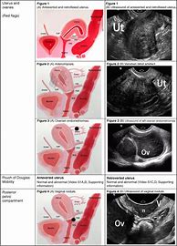 Image result for Endometrioma Cyst