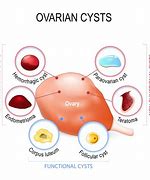 Image result for Ovarian Cysts and Fibroids