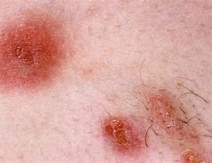 Image result for MRSA Disease