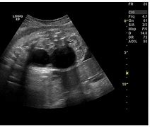 Image result for Fetal Ovarian Cyst Ultrasound