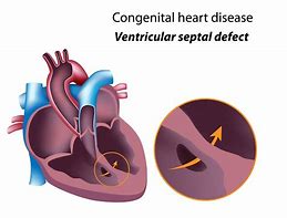 Image result for Congenital Heart Defect