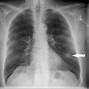 Image result for Benign Lung Nodules