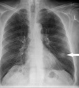 Image result for 2 Cm Nodule On Lung