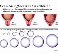 Image result for Graphic Labor Dilation Chart