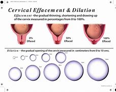 Image result for Dilation in Birth