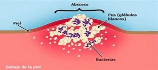 Image result for abscezo