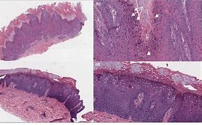 Image result for Verruca Plana Histology