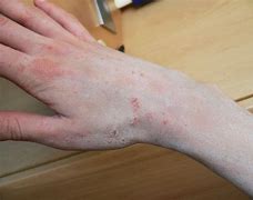 Image result for Scabies