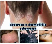 Image result for seborrea