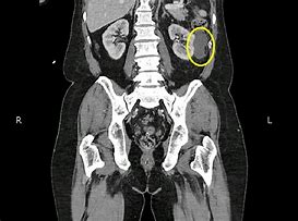 Image result for RT Kidney Mass