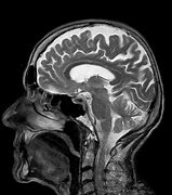 Image result for Benign Brain Tumor