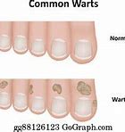 Image result for Common Wart Diagram