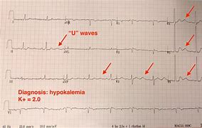 Image result for U Wave ECG Hypokalemia