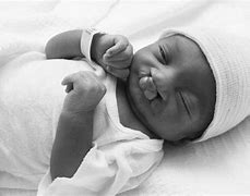 Image result for Trisomy 18 Syndrome Babies